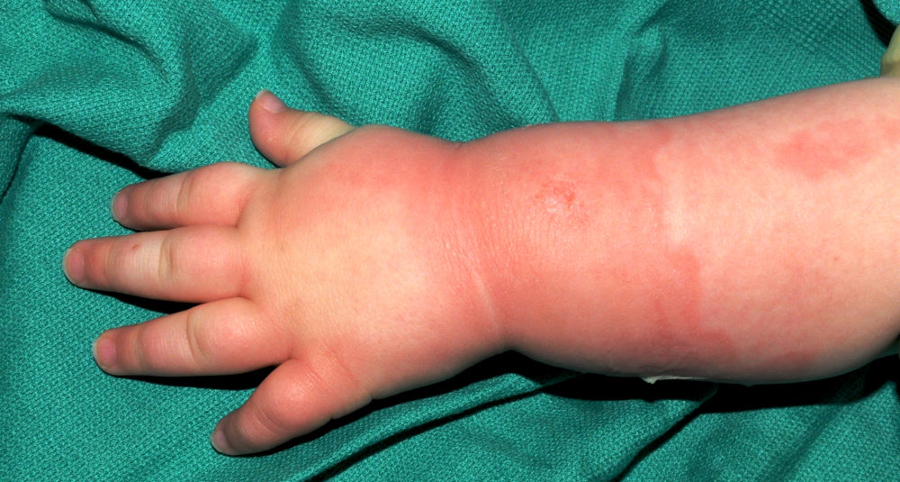 Photo of a First-Degree Burn