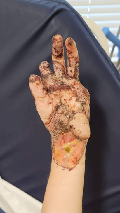 DIY gone wrong: burn surgeons save woman's hands after wood