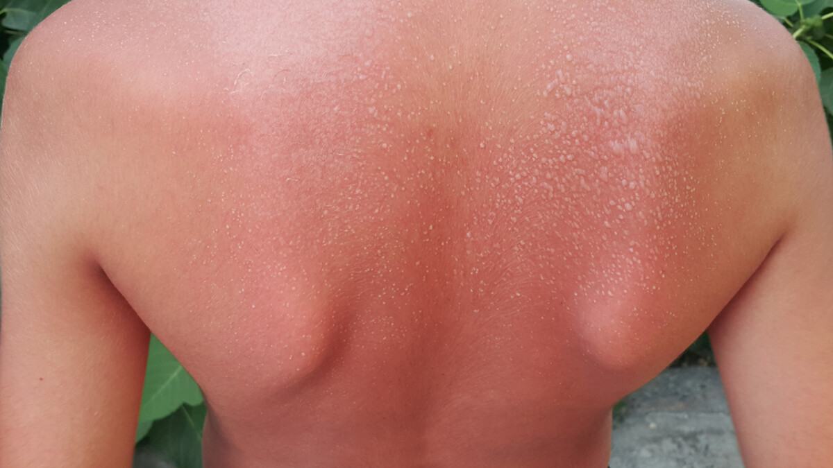 Blisters on the back from sunburn. A young guy on vacation at the beach caught fire from the rays of the sun. Reddened back. Ultraviolet rays. Global climate warming.